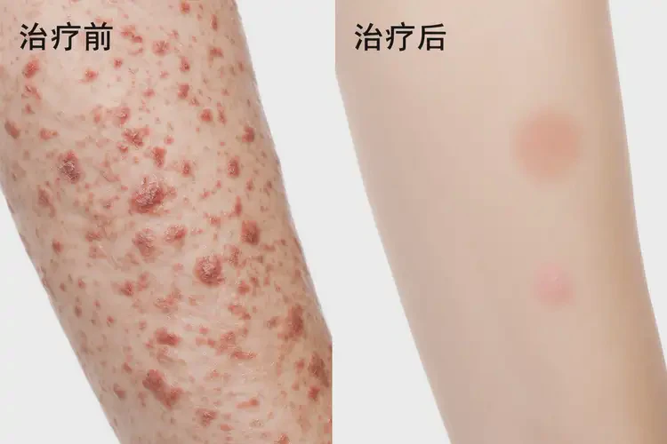 哺乳期媽媽四肢出現(xiàn)濕疹能夠徹底治愈嗎(圖1)