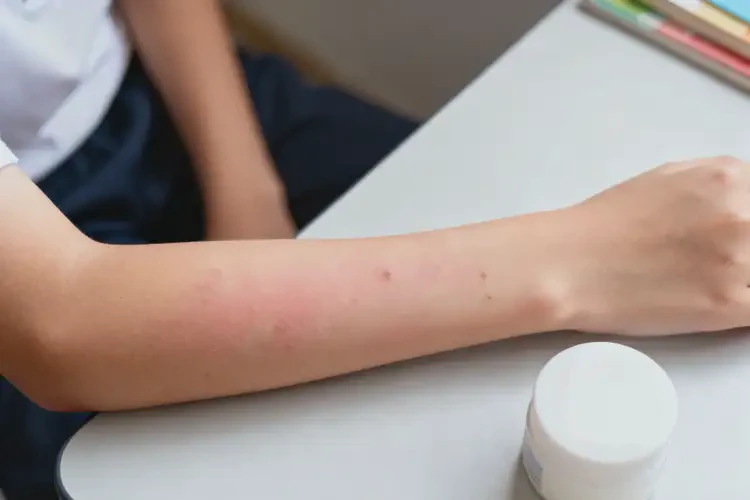 中學(xué)生四肢偶爾起濕疹能徹底自愈嗎(圖4)