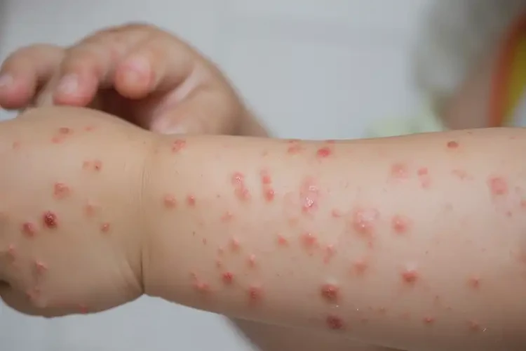 少兒手臂上長(zhǎng)濕疹能夠徹底治愈嗎(圖4)