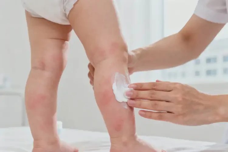 嬰兒小腿偶爾長濕疹能夠徹底治愈嗎(圖1)