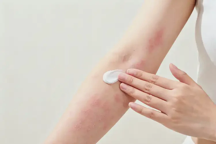 女性手臂上容易起湿疹能够彻底治愈吗(图1)