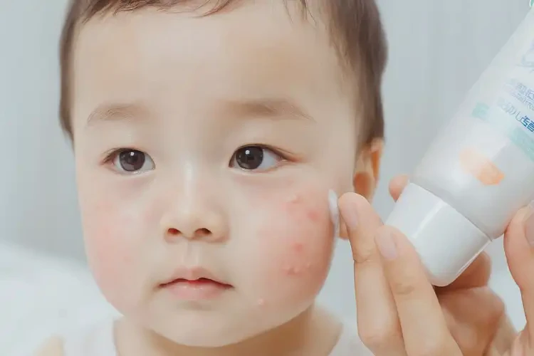 孩子臉上偶爾起濕疹能靠自己自愈嗎(圖4)