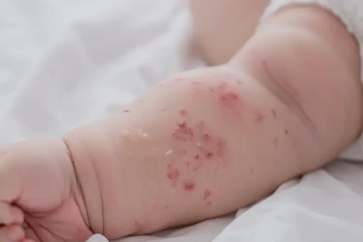 新生兒身上起濕疹能徹底自愈嗎(圖4)