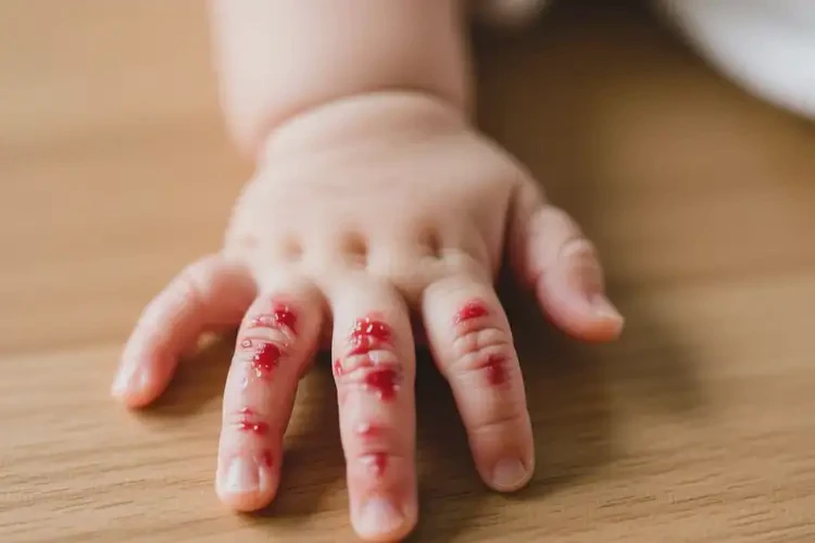 新生兒手上經(jīng)常起濕疹不管它會(huì)自己自愈嗎(圖1)