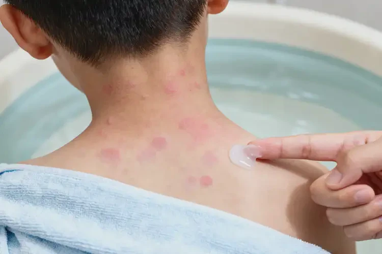 小學生脖子出濕疹能靠自己自愈嗎(圖2)