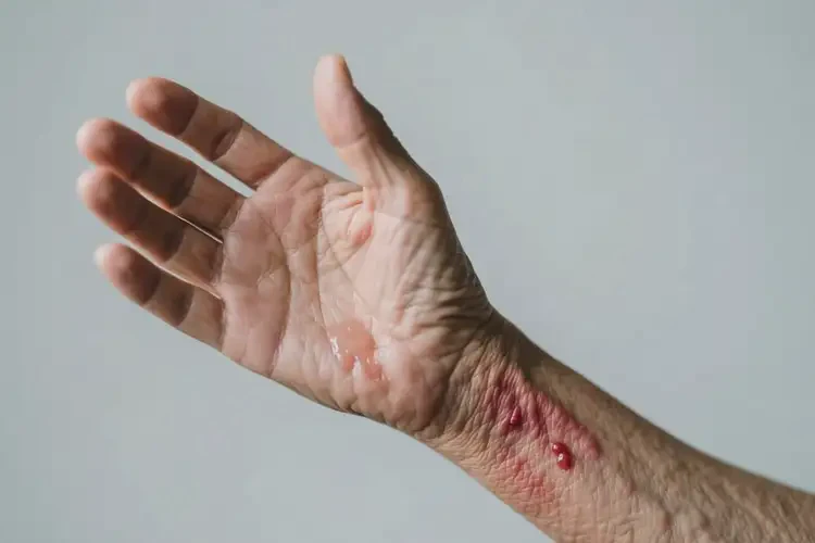 老人手臂上起濕疹可以徹底自愈嗎(圖3)