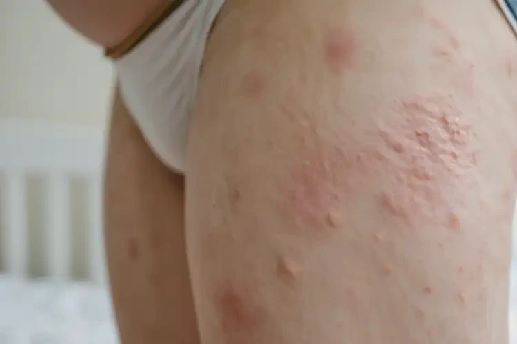 哺乳期妈妈大腿长湿疹可以彻底自愈吗(图3)