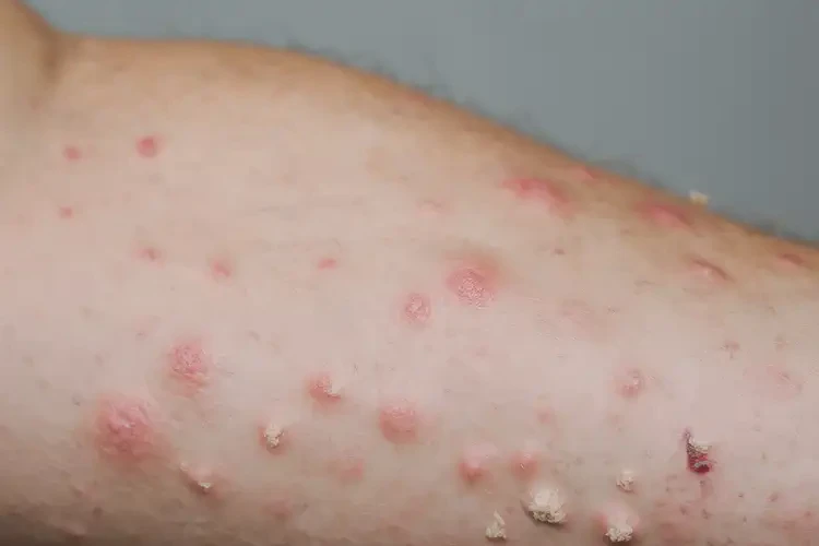 男生身上偶爾起濕疹能靠自己自愈嗎(圖3)