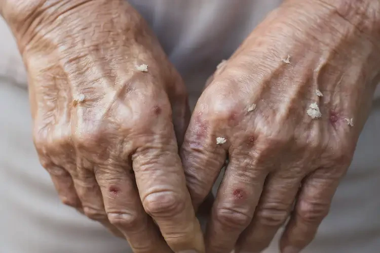 高龄老人手上经常起湿疹可以彻底自愈吗(图4)