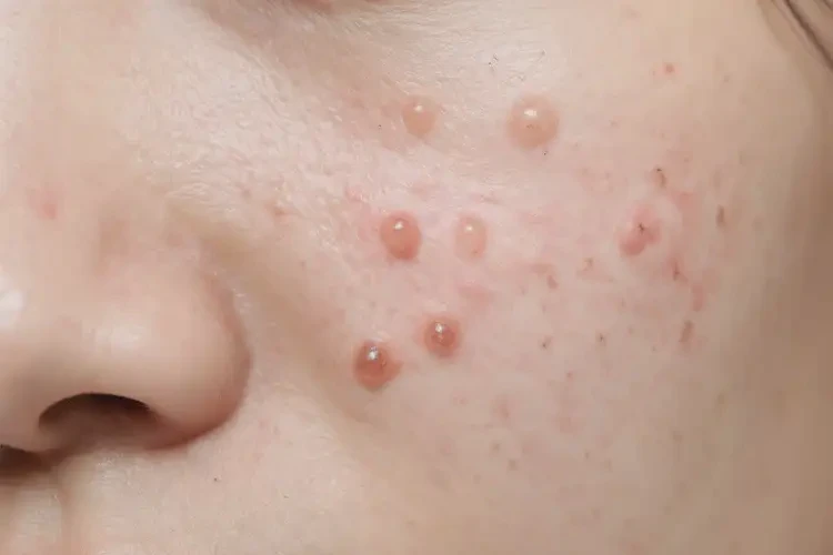 大學(xué)生肛周有濕疹能不能徹底自愈(圖4)