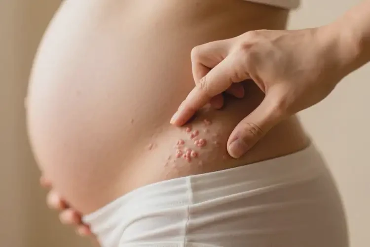 產(chǎn)婦屁股上偶爾長濕疹能夠徹底治愈嗎(圖1)