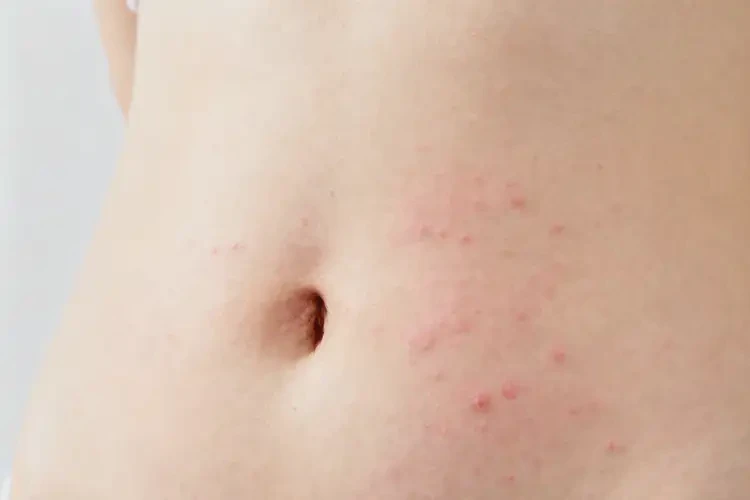 女生肚子上偶爾長濕疹能徹底自愈嗎(圖1)