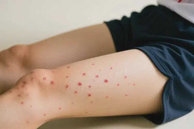 中學(xué)生大腿上偶爾起濕疹不管它會(huì)自己痊愈嗎(圖2)