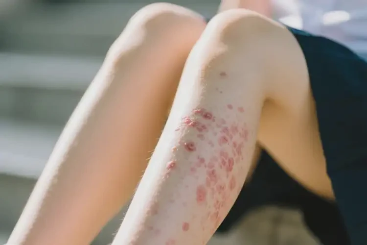 大學(xué)生大腿上偶爾長(zhǎng)濕疹可以徹底自愈嗎(圖4)