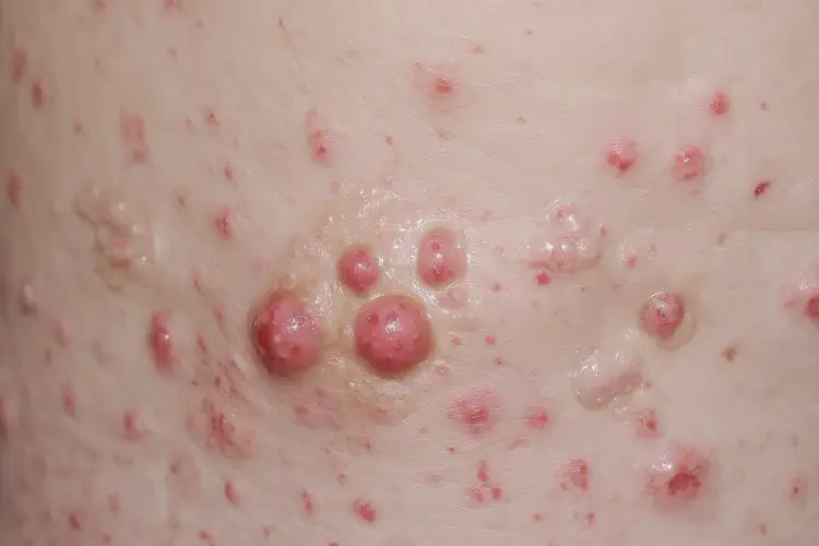 男人肛周經(jīng)常長(zhǎng)濕疹不管它會(huì)自己自愈嗎(圖4)