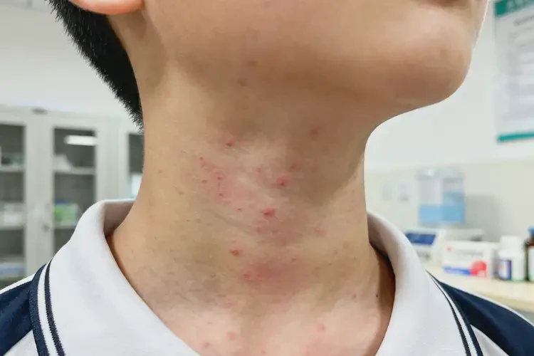 中學(xué)生脖子容易長(zhǎng)濕疹可以徹底自愈嗎(圖1)