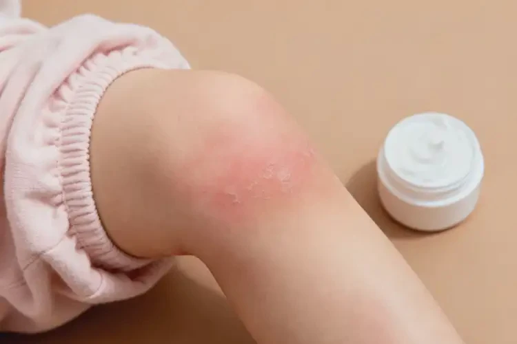 孩子大腿偶爾起濕疹不管它會自己痊愈嗎(圖1)