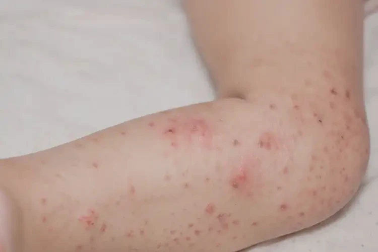 少兒小腿經(jīng)常長濕疹能夠徹底治愈嗎(圖3)