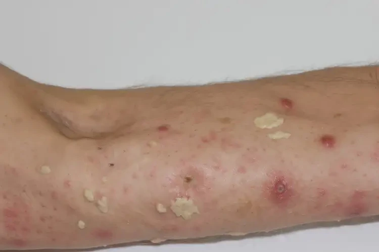 男人身上出濕疹不管它會(huì)自己好嗎(圖2)