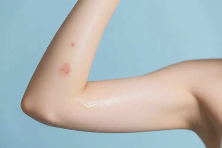 青年人手臂上偶爾起濕疹可不可以徹底自愈(圖1)