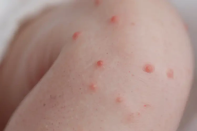 新生兒小腿容易起濕疹能徹底自愈嗎(圖4)