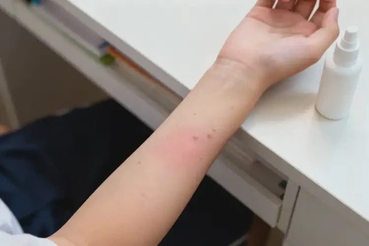 中學(xué)生四肢偶爾起濕疹能徹底自愈嗎(圖1)