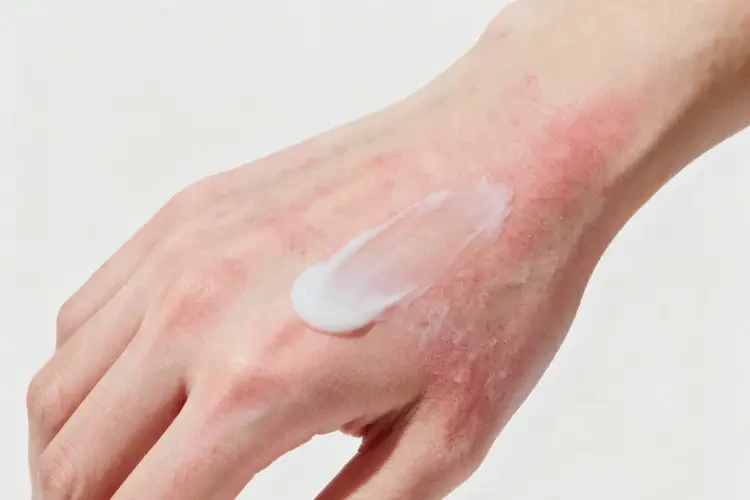 大学生手上偶尔长湿疹能彻底自愈吗(图3)