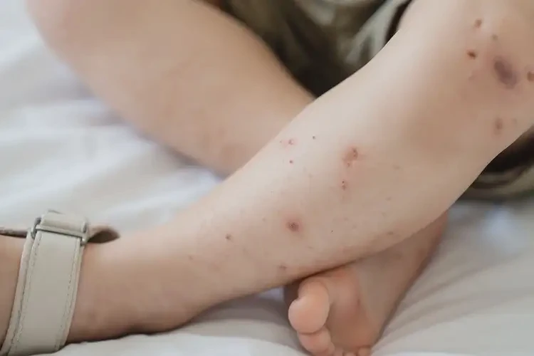 少兒腳上出濕疹能靠自己自愈嗎(圖4)