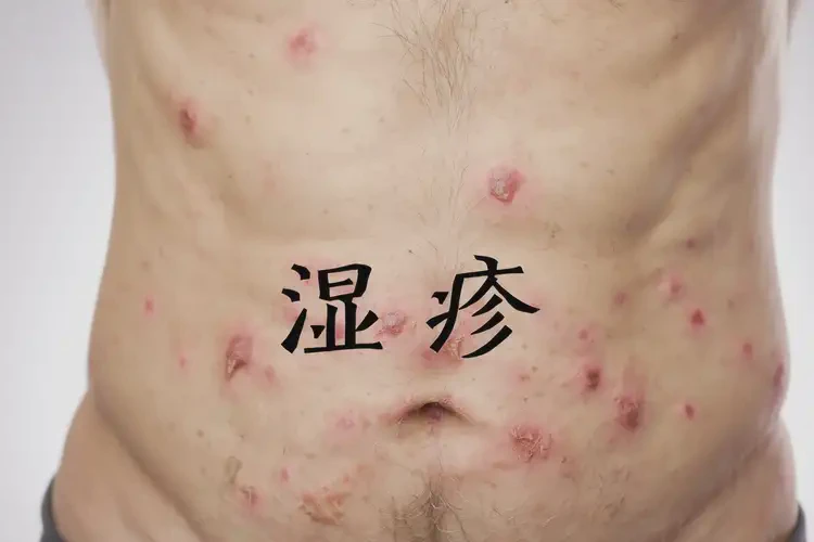 男性肚子上出現(xiàn)濕疹可不可以徹底自愈(圖4)