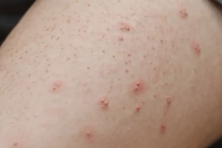 男生大腿上出現(xiàn)濕疹不管它會(huì)自己好嗎(圖4)