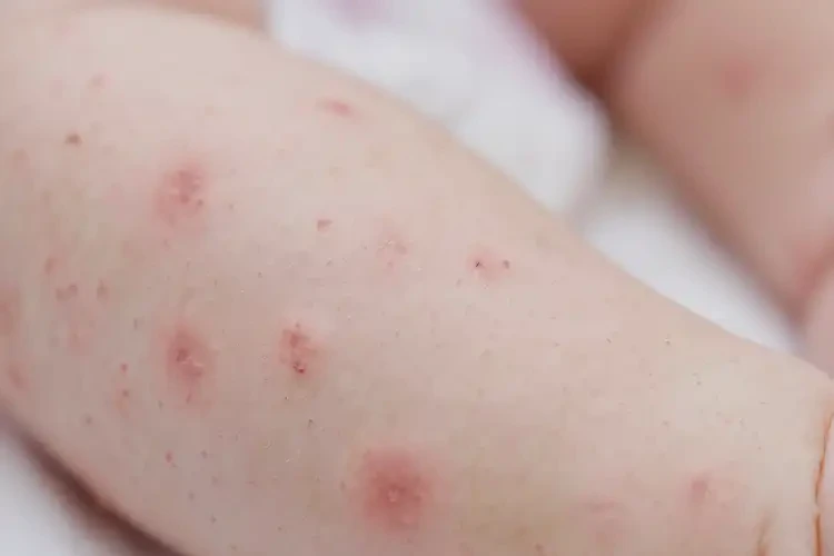 新生儿手臂上容易起湿疹不管它会自己痊愈吗(图4)