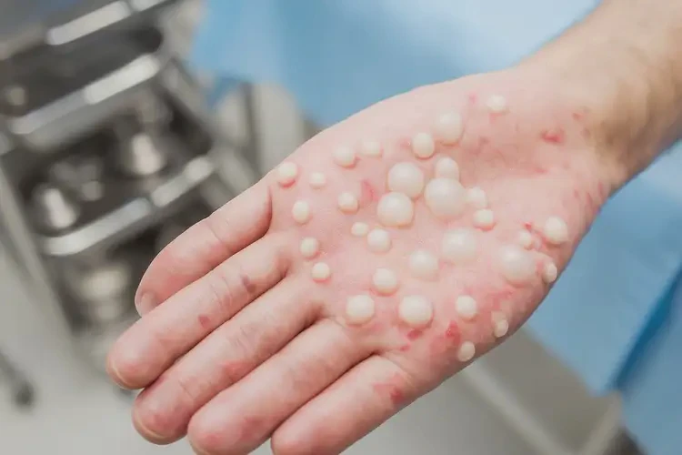 青年人腳上偶爾長濕疹不管它會自己好嗎(圖2)