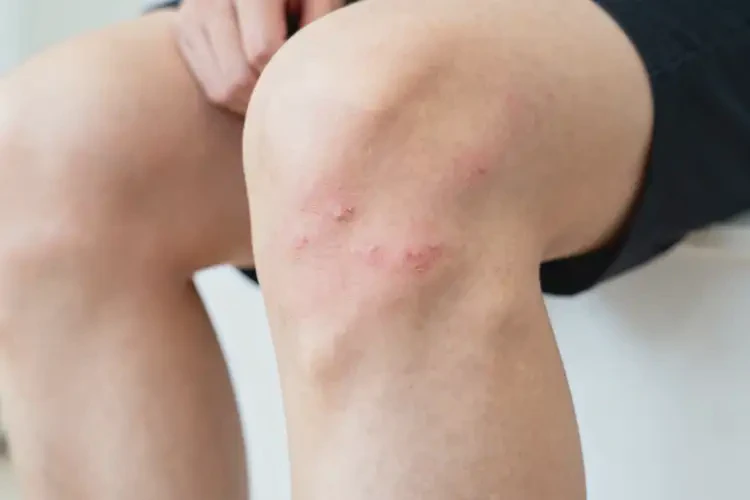 青年人大腿上容易長(zhǎng)濕疹能徹底自愈嗎(圖3)