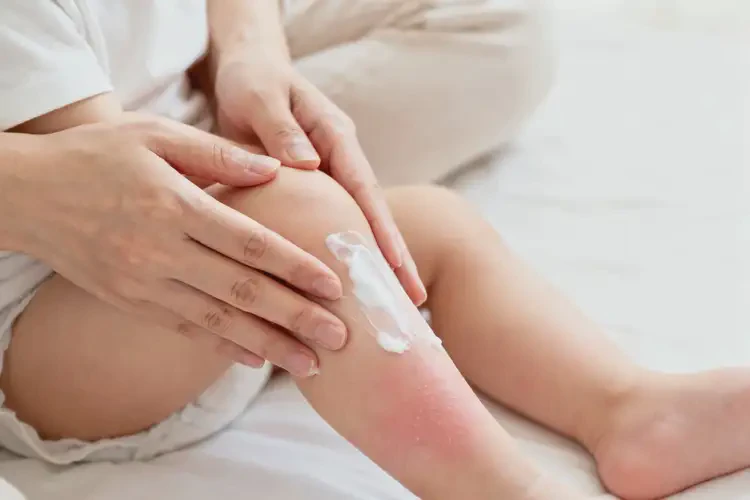 嬰幼兒四肢出濕疹可不可以徹底自愈(圖4)