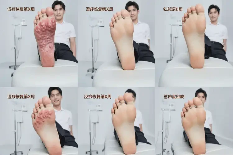 青年人腳上偶爾長(zhǎng)濕疹不管它會(huì)自己痊愈嗎(圖4)