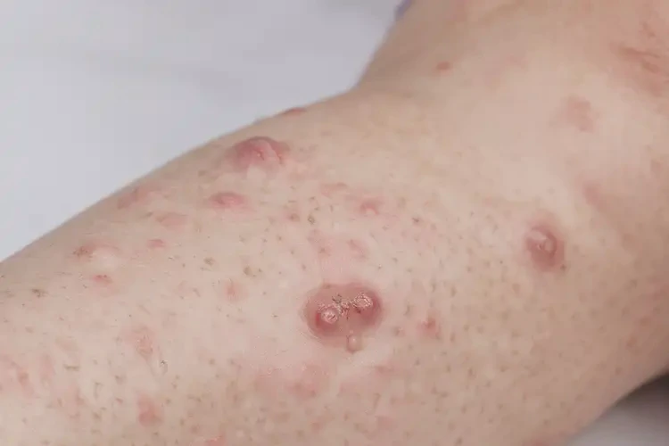 小兒小腿上容易長濕疹能靠自己自愈嗎(圖4)