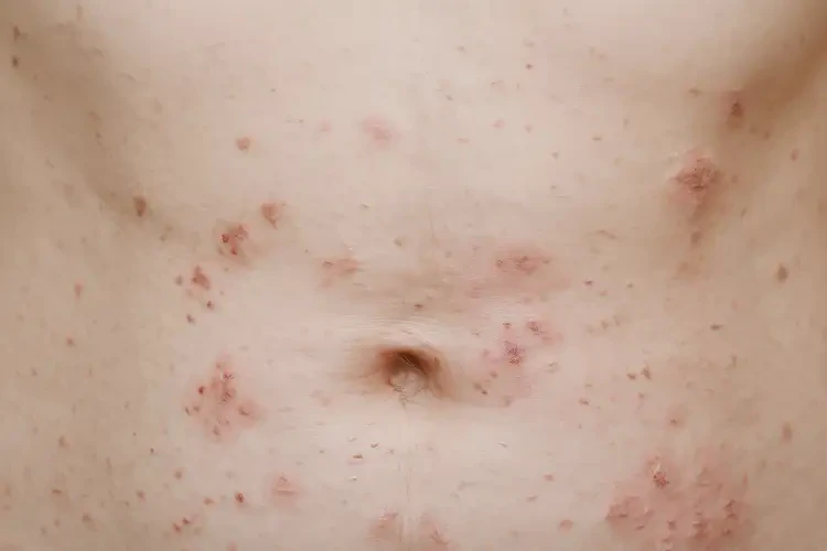 女性肚子上經(jīng)常起濕疹不管它會自己痊愈嗎(圖4)