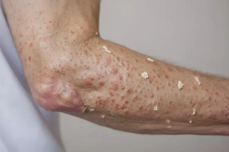 男生身上偶爾起濕疹能靠自己自愈嗎(圖2)