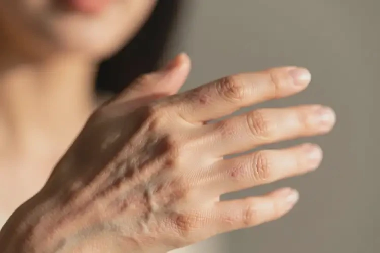 女性身上出現(xiàn)濕疹能徹底自愈嗎(圖4)