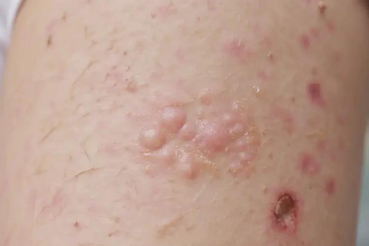 少兒身上有濕疹可不可以徹底自愈(圖4)