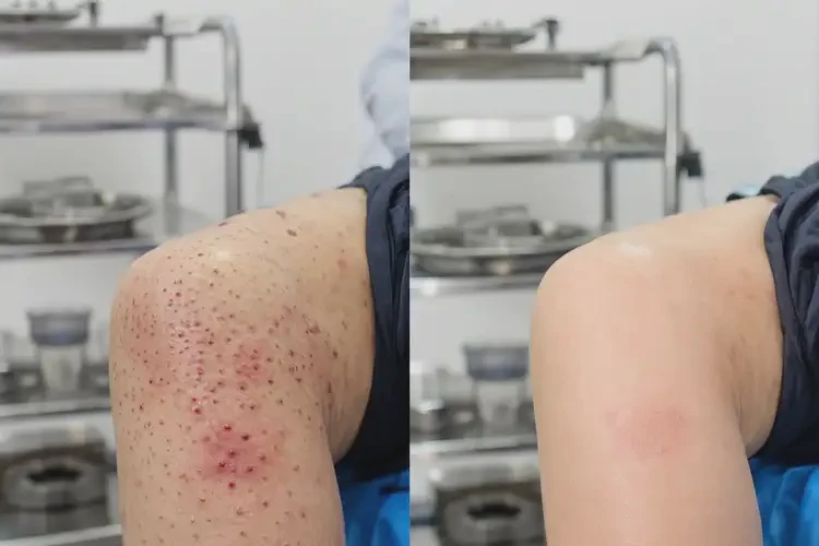 大學(xué)生肛周有濕疹不管它會(huì)自己好嗎(圖1)