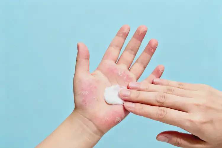 少儿手上容易长湿疹能够彻底治愈吗(图3)