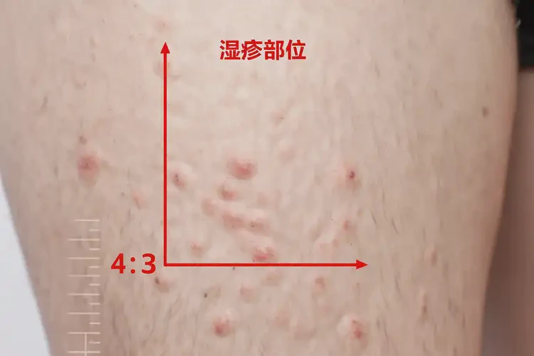 青年人大腿起濕疹不管它會自己自愈嗎(圖4)