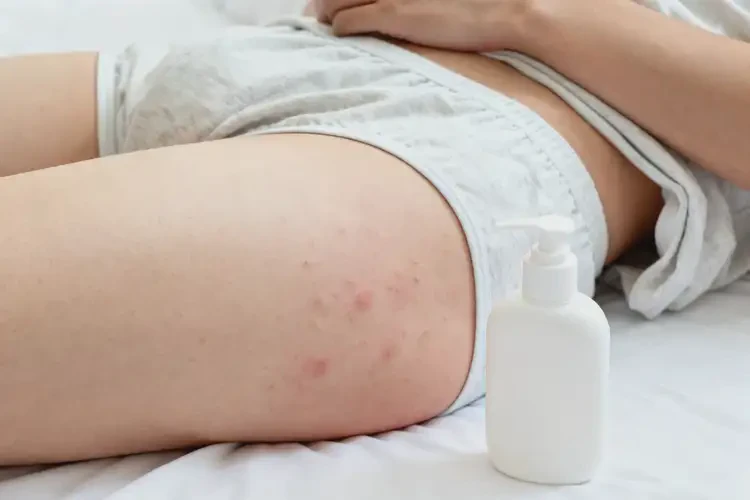 青年人屁股上有濕疹不管它會自己好嗎(圖1)