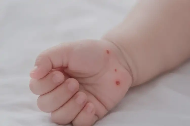 嬰兒手上出濕疹不管它會(huì)自己痊愈嗎(圖4)