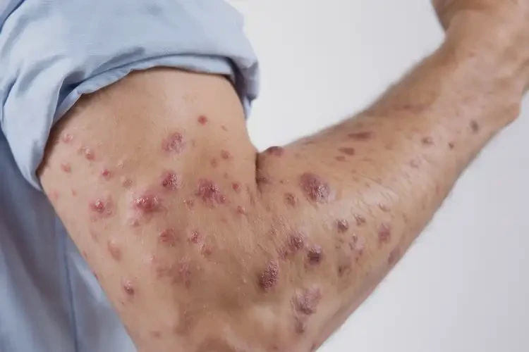 男人手臂上容易長濕疹不管它會(huì)自己痊愈嗎(圖4)