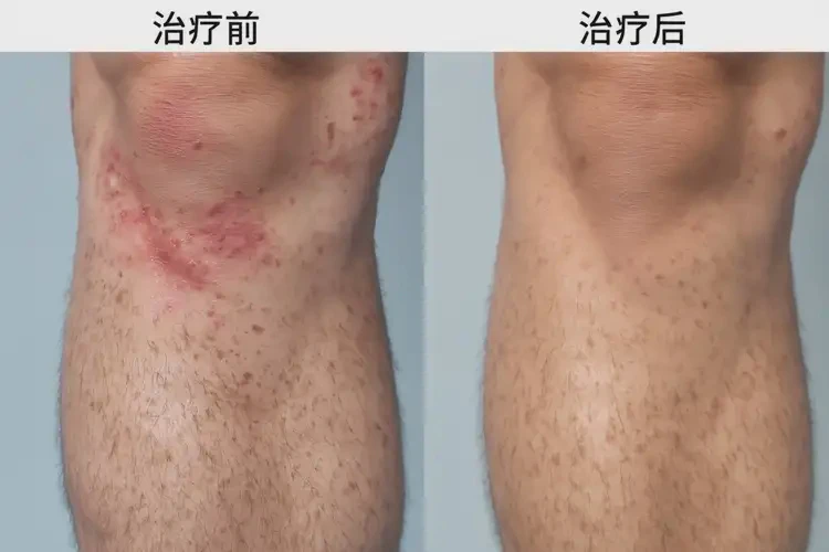 男生大腿經(jīng)常長(zhǎng)濕疹可以徹底自愈嗎(圖1)