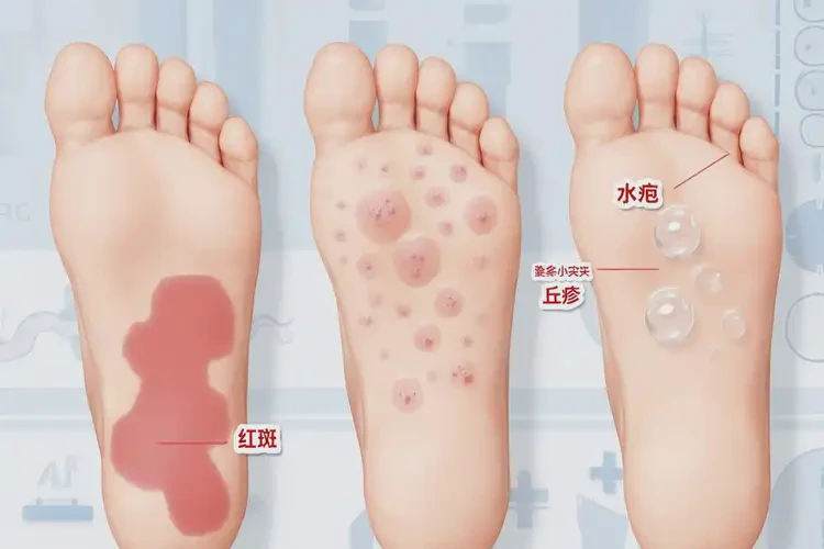 小儿脚上偶尔长湿疹能够彻底治愈吗(图4)