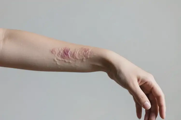 青年人手臂上偶爾起濕疹可不可以徹底自愈(圖3)