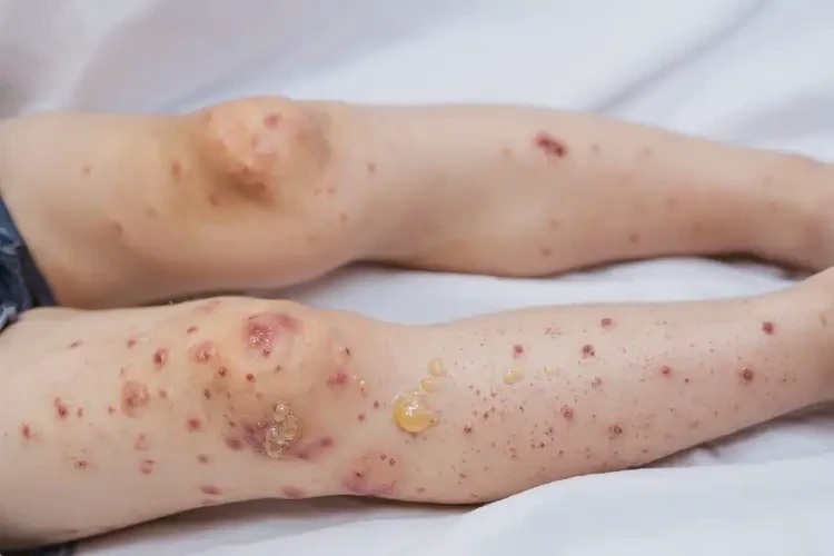 孩子小腿上偶爾長濕疹不管它會自己好嗎(圖1)